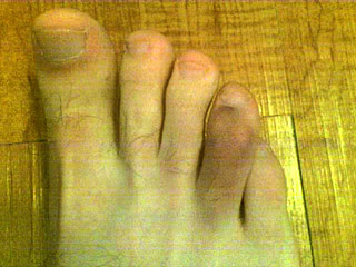 my wonky toe